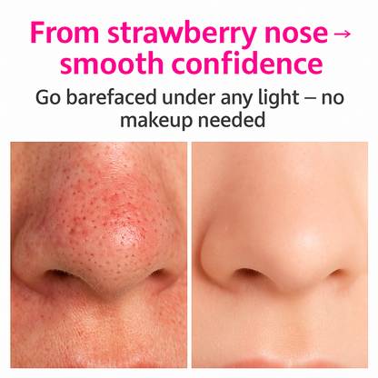 Seloura Montréal Blackhead Remover Pore Vaccum