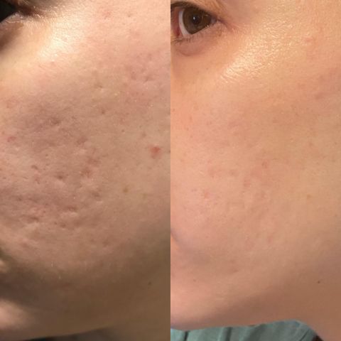 Feuilles de silicone pour cicatrices